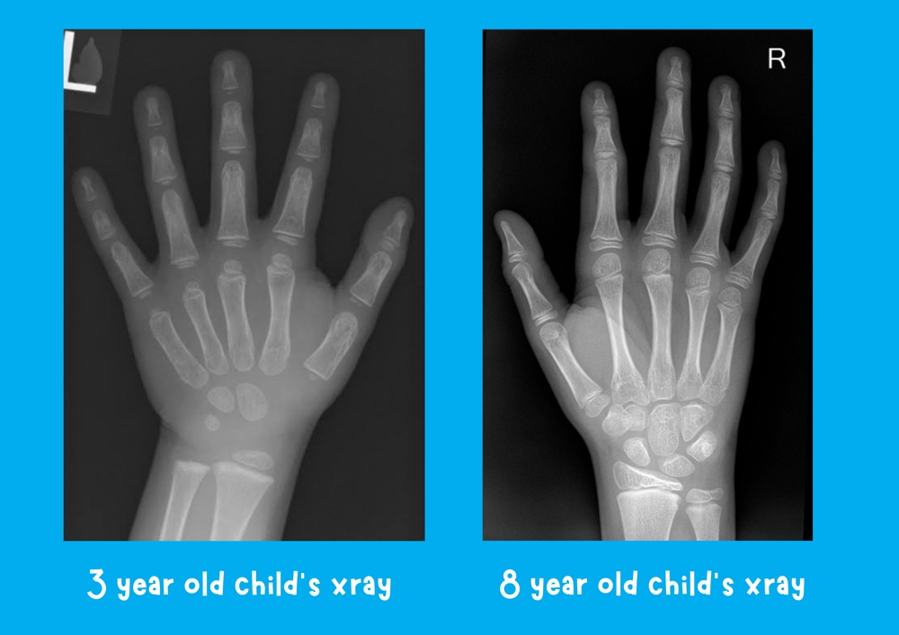 xray showing the developmental difference between a 3 year old's hand and an 8 year old's hand development